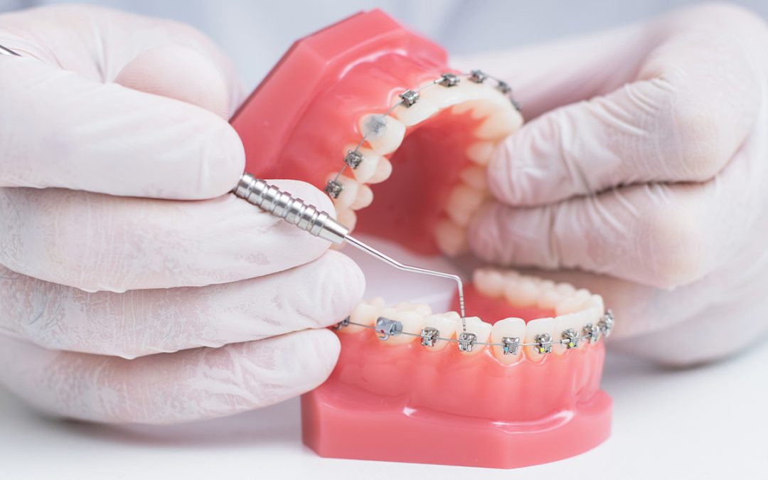 Mobilna ili fiksna proteza – šta je bolje i kako da izaberete (Niš vodič)