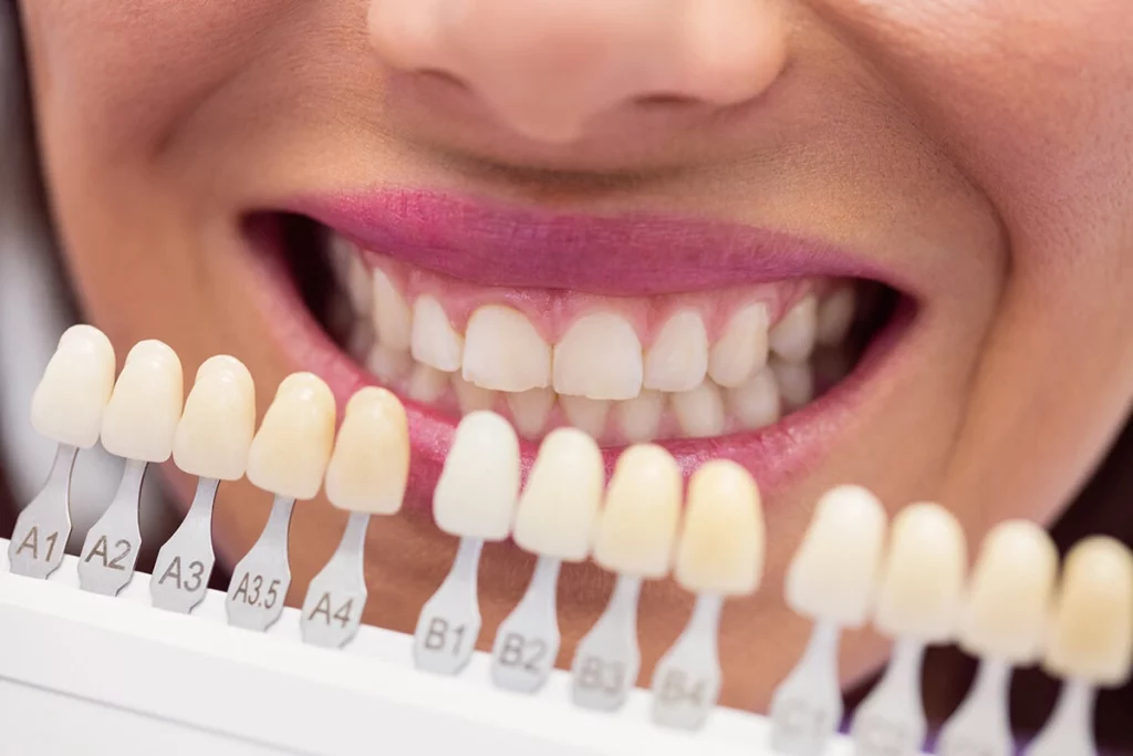 Izbor nijanse za fasete Određivanje nijanse zuba pri izradi faseta u stomatološkoj ordinaciji Branko Dental Tehno u Nišu