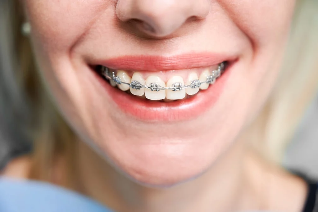 Osmeh sa fiksnom zubnom protezom – ortodoncija, Branko Dental Tehno Niš