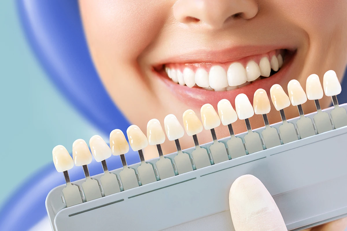 Biranje nijanse zuba pomoću skale boja za izradu krunice u ordinaciji Branko Dental Tehno